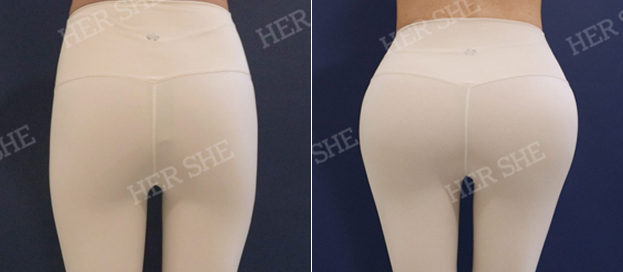 엉덩이필러 전후